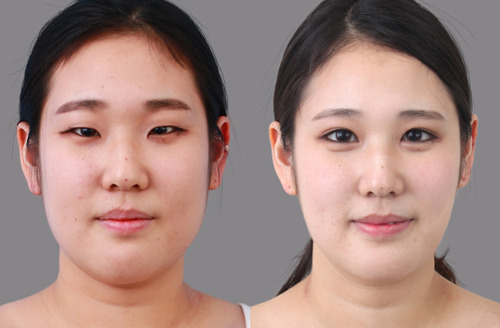 eyelid surgery korea cost